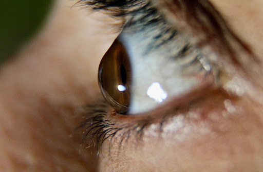 Close up of individuals eye with keratoconus