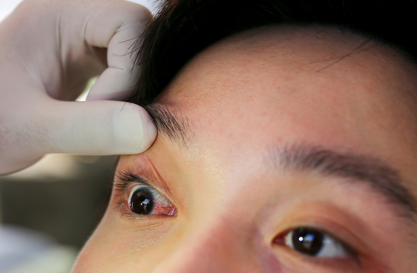 Close up of eye that is red and swollen.