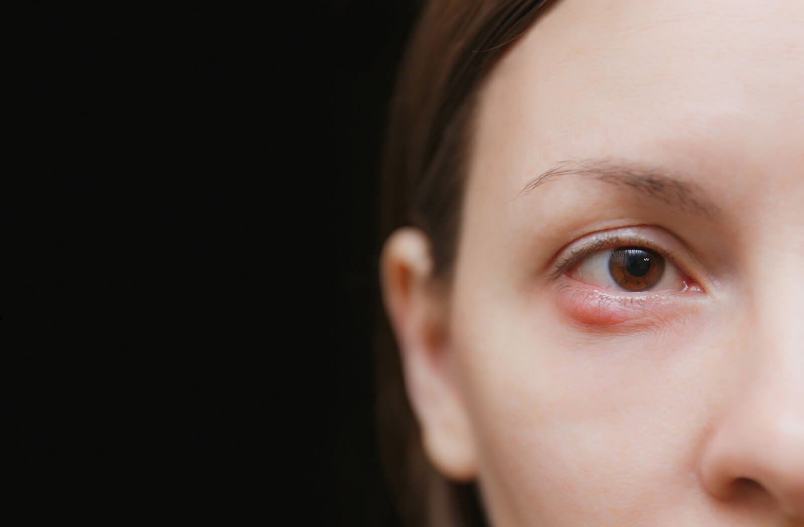 Close-up of a woman's face against a black background showing her right eye with a stye on it.