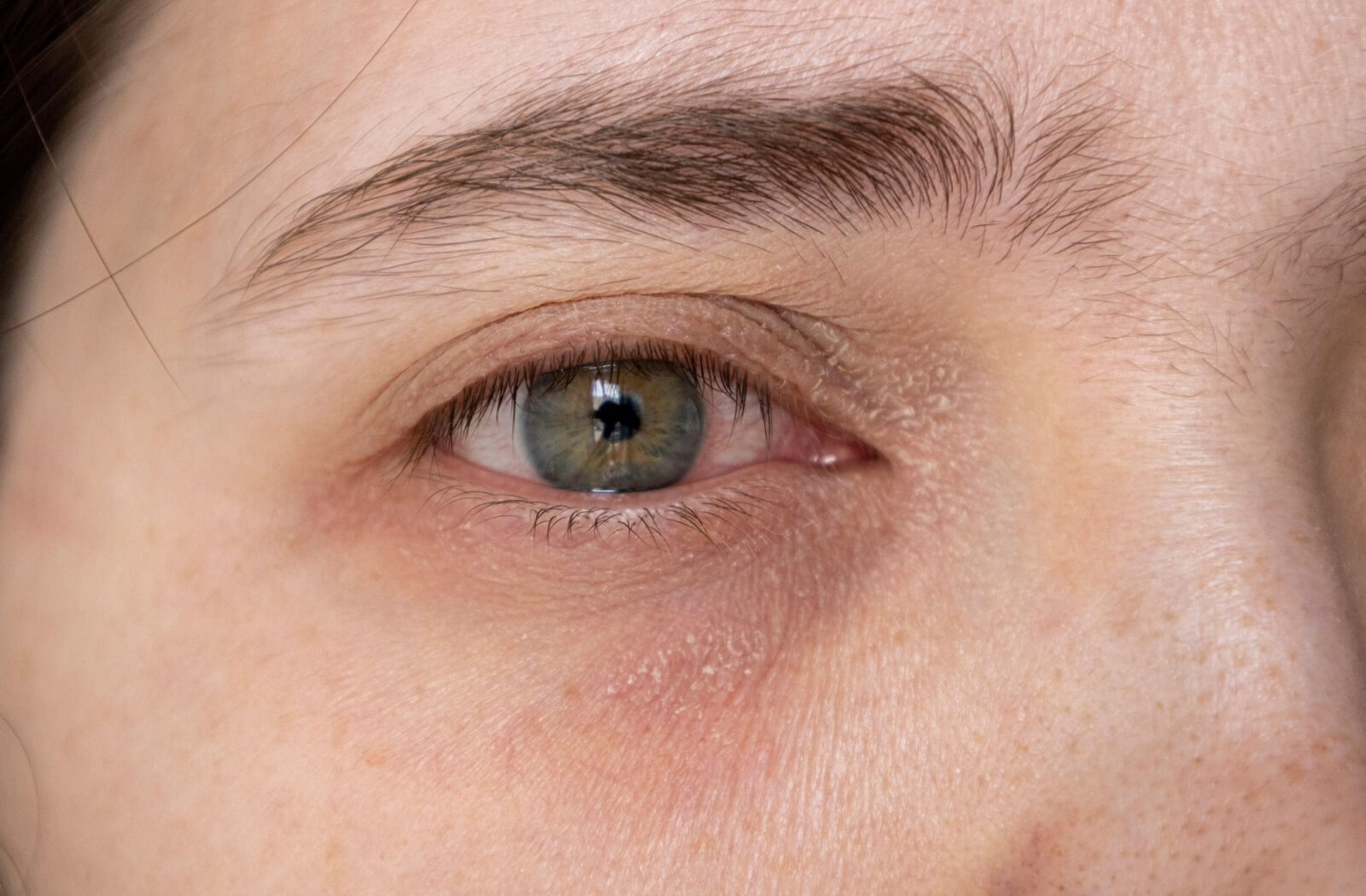 A close-up of an irritated human eye with visible redness in the white of the eye and dry, flaky skin on the surrounding eyelids.